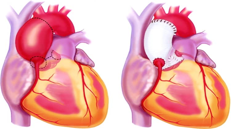  Aortic Aneurysm treatment in Hyderabad