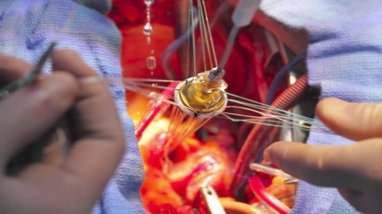 best heart valve repair doctors in hyderabad